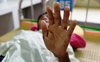 Quảng Ngãi khẩn cấp phòng bệnh viêm da dày sừng bàn tay bàn chân