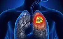 Phát hiện khối u ác tính ở phổi sau thời gian dài bị ho