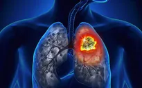 Ung thư phổi giai đoạn sớm, các yếu tố nguy cơ không thể bỏ qua