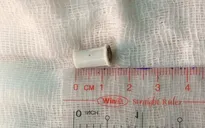 Hóc đầu kèn nhựa, bé trai 6 tuổi ở Đồng Nai suýt chết