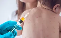 Dịch sởi có nguy cơ bùng phát trở lại tại Mỹ
