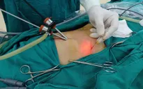 Trẻ đau bụng quanh rốn, vào viện phát hiện dị vật kim loại đâm thủng ruột non