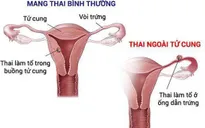 Thai ngoài tử cung - phát hiện và điều trị thế nào?