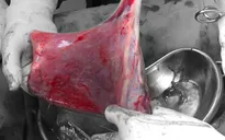Cứu sống thai nhi có dây rốn bám màng hiếm gặp