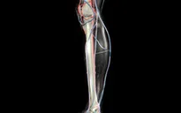 Kỹ thuật mới trong điều trị hẹp động mạch chi dưới