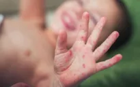 Dịch sởi tái xuất tại Mỹ: Nguyên nhân có thể do không tiêm vaccine