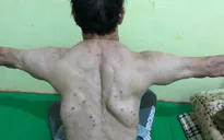 Nổi u khắp người do uống rượu