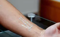 Miếng dán hỗ trợ điều trị bệnh Parkinson
