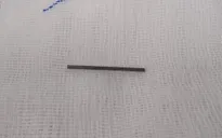 Nuốt thanh cầu bánh xe đồ chơi, bé trai 4 tuổi nhập viện cấp cứu