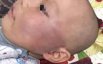 Tát bé trai 19 tháng sưng vù mặt, bảo mẫu nói dối bé ngã cầu thang