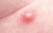 Nổi mụn bất thường ở "vùng kín" - Chị em chớ chủ quan