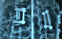 3 ca mổ liên tiếp cứu người đàn ông bị rơi từ độ cao 8m