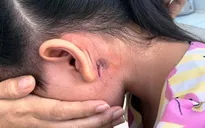 Bé 5 tuổi ở Bình Định mắc bệnh Whitmore