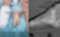 Cứu người đàn ông bị máy cắt cỏ cắt đứt lìa bàn chân