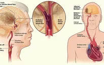 Bệnh nhân rung nhĩ có nguy cơ đột quỵ cao