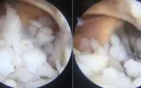 Gắp hàng trăm viên "sỏi" trong khớp khuỷu tay nam thanh niên