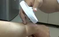 Dày sừng nang lông - Căn bệnh khiến nhiều người khổ sở vào mùa đông