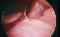 Mảnh xương cá chuồn "trốn" ở đáy lưỡi một phụ nữ
