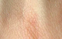 Mỹ lần đầu tiên dùng da lợn biến đổi gene cấy ghép cho người