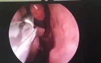 Hãi hùng: Vắt chui vào mũi sống sau khi uống nước suối khi đi phượt