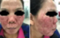 Đẹp hay hại da từ phương pháp lột da?