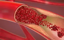 Kỳ lạ người đàn ông bị mất vị giác do thiếu máu