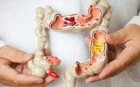 Công nghệ mới phát hiện sớm ung thư đại trực tràng