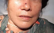 Phát hiện ung thư da từ nốt sùi trên mũi