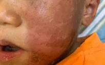 Coi chừng tổn thương da trẻ trong mùa Halloween