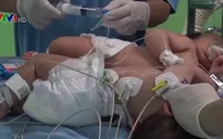 Sức khỏe 2 trẻ sơ sinh dính liền hồi phục tốt sau tách gan