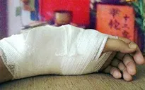 Phải nhập viện chỉnh xương gãy sau 20 ngày "đặt niềm tin" vào thuốc nam