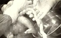 Nút thắt dây rốn - Mối nguy hiểm tiềm ẩn