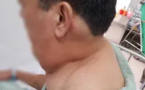 Uống 1 lít rượu mỗi ngày, biến dạng mặt, cổ vì... u mỡ