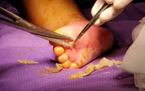 Người lớn sơ ý, trẻ bị bỏng nước sôi nhập viện
