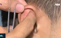 Hiệu quả phương pháp cai nghiện thuốc lá bằng nhĩ châm