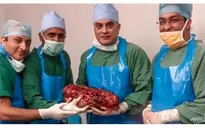 Phẫu thuật cắt bỏ quả thận khổng lồ nặng 7,4 kg của một bệnh nhân Ấn Độ