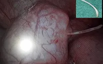 Buộc phải cắt bỏ túi thừa Meckel do xương cá đâm thủng