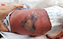 Trẻ sơ sinh bỏng nặng, nhiễm trùng máu do sưởi ấm bằng than