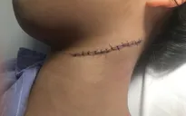 Hy hữu: Bé gái bị cứa đứt cổ vì ngã vào... mảnh sành