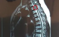 Liệt hai chân vì khối u tủy chèn ép