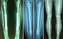 Kéo dài chân an toàn - Những điều cần biết