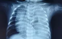 Cứu bé 3 tháng tuổi phổi trắng xóa vì rò dịch dưỡng chấp