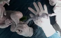 Bé gái sinh mổ với hai nút thắt dây rốn nguy hiểm