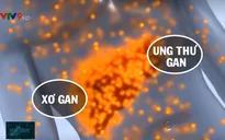 Ung thư gan - Căn bệnh ung thư gây tử vong hàng đầu ở Việt Nam