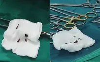 Đau bụng nhiều ngày, vào viện phát hiện... hàng nghìn con sán lá gan trong đường mật