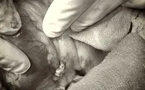 Cứu nam thanh niên bị dập tim do tấm bê tông đè