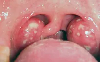Có cần thiết cắt amidan ở mọi người hay không?