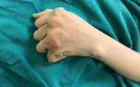 Giúp đôi tay hoạt động trở lại sau 10 năm bị viêm khớp dạng thấp