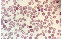 Indonesia: Lo ngại bệnh tan máu bẩm sinh gia tăng