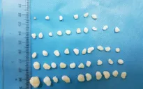Lấy 45 viên sỏi màu trắng trong... khớp vai